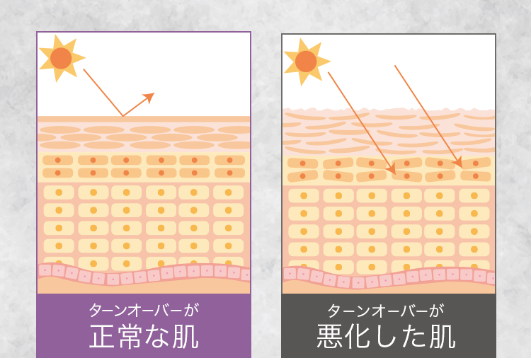 ターンオーバーが正常な肌と悪化した肌